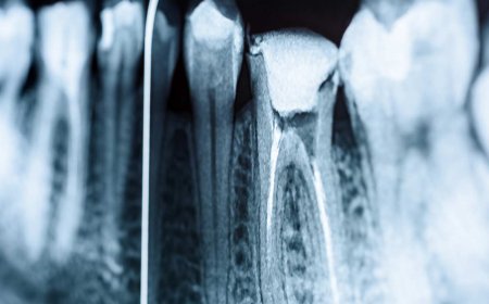 Root Canal Treatment: Unexpected Health Benefits - Bio Points News