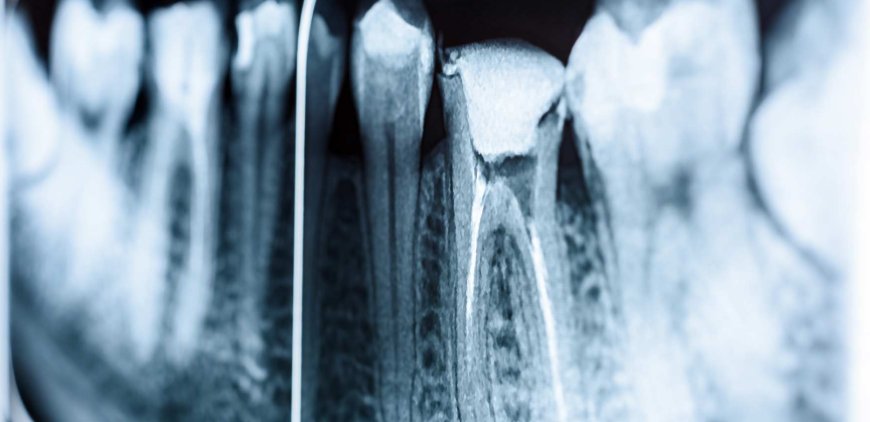 Root Canal Treatment: Unexpected Health Benefits - Bio Points News